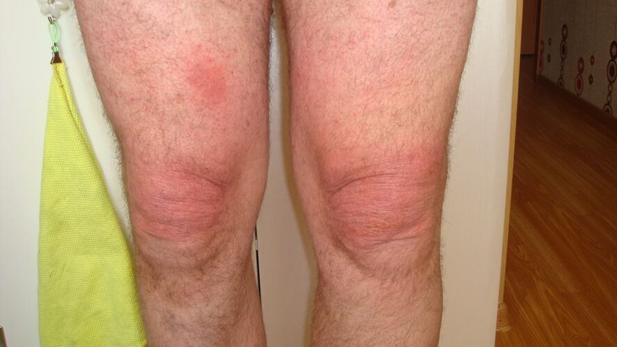 artrosi delle articolazioni del ginocchio